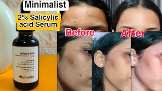 Minimalist 2 Salicylic acid Face Serum  My Honest Review  How I cleared my Skin✅ [upl. by Neelyam82]