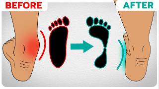 How to Correct Overpronation Fallen Arches [upl. by Nimajeb]