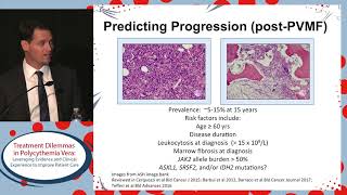 Prognostication and initiation of therapy in Polycythemia vera Do we have it right [upl. by Kappel]