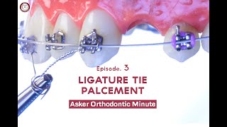 LIGATURE TIE Asker Orthodontic Minute Episode 3 [upl. by Touber]