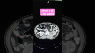 Renal Cell Carcinoma shorts viral trendingshorts [upl. by Ecinehs]