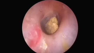 WOW SHOCKING EAR STONE REMOVAL PROCESS [upl. by Tessler]