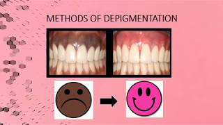 Gingival Melanin Depigmentation  Case Report [upl. by Atem]