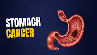 8 Strange Signs of STOMACH CANCER Gastric Cancer Symptoms [upl. by Souvaine]