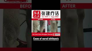 Real treatment cases of cured ichthyosis ichthyosis skincare dermatologist dryskinremedy [upl. by Hnim]