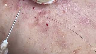 Big Cystic Acne Blackheads Extraction Blackheads amp Milia Whiteheads Removal Pimple Popping [upl. by Dee Dee]