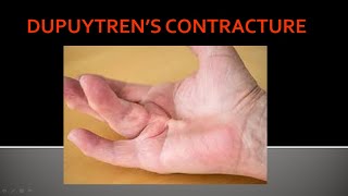 Dupuytrens contracture Causes Pathology Clinical features Diagnosis amp Treatment [upl. by Margarita]