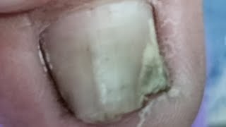 BIG TOES ONLY HOW TO PEDICURE TRANSFORMATION FOR MEN ON DETACHED TOENAIL [upl. by Fiore]