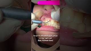 Diode laser frenectomy by Dr Ali Heidari [upl. by Malita]