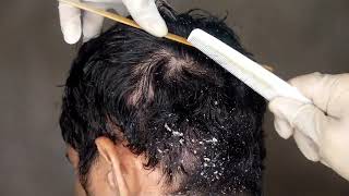 Dandruff Scratching My Husband Has Big Flakes  NO TALKING Pt 11  Hair Cleaning [upl. by Irik]