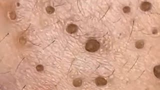 Blackheads amp Whiteheads Satisfying Removal 0116 [upl. by Jahncke]