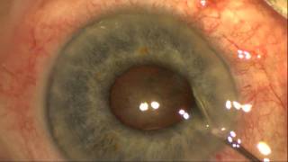 Flomax Use Makes Cataract Surgery More Challenging [upl. by Culhert909]