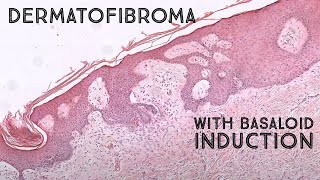 Dermatofibroma with basaloid follicular induction mimic of basal cell carcinoma pathology [upl. by Lucien483]