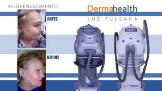 Luz Intensa Pulsada  Criofrequência Dermahealth [upl. by Rozele]