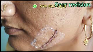 stitches scar plastic surgery in vadodara  Remove Stitch  stitches scar laser treatment [upl. by Adnalue]