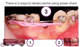 canine traction by power chain in orthodontics by dr Amr Asker [upl. by Pandolfi]