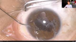 Lecture Secondary Intraocular Lens IOLs in Aphakia [upl. by Nomsed494]