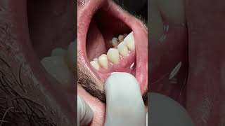 Tooth crowns after RCT satisfying [upl. by Topliffe]