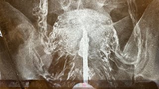 Asherman Hydrodissection Total reconstruction by Osama Shawki [upl. by Sugihara]