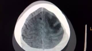 ASTROCITOMA DE ALTO GRADO VERSUS GLIOBLASTOMA MULTIFORME [upl. by Eeneg]