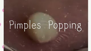 Pimples amp Blackheads Popping  59 [upl. by Vedi]