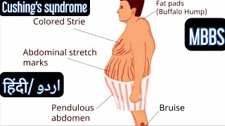 Cushing Syndrome in Hindi [upl. by Amatruda]