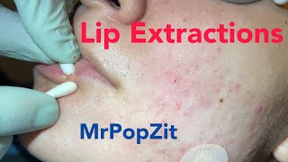 Lip extractions Whiteheads blackheads acne extractions on face Inflammatory pustules [upl. by Animrelliug]