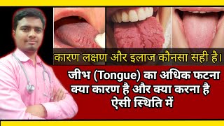 Cracked Fissure On Tongue जिव्हा पर गहरी दरार बनना कारण लक्षण और इलाज Best Homeopathic Treatment [upl. by Martyn]