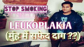 Leukoplakia Causes Symptoms Management amp Treatment  मुंह में सफेद और लाल दाग़ होना [upl. by Mosnar499]