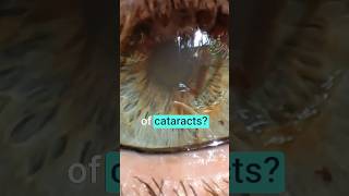 WARNING 4 Early Signs of Cataracts [upl. by Nitsoj602]