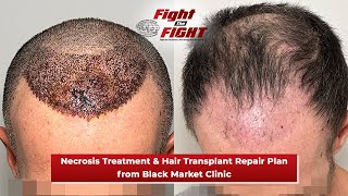 Necrosis from Black Market Clinic  Treatment amp Hair Transplant Repair Plan by Maxim Chumak MD [upl. by Kellsie]