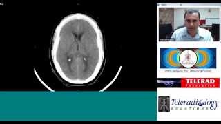 Subarachnoid Hemorrhage radiology teaching by Dr Arjun Kalyanpur [upl. by Dirgni]