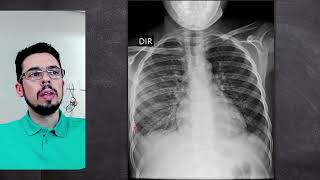 Congestão pulmonar e síndrome nefrítica [upl. by Enelec]