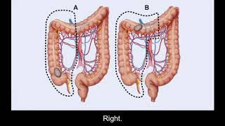 Surgery Treatment Options for Colorectal Cancer  Memorial Sloan Kettering [upl. by Adnohsirk]