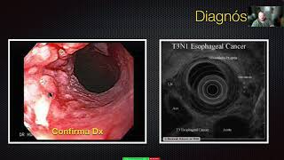 Tumores de Esófago [upl. by Klinges399]