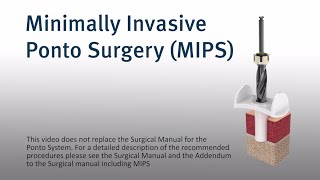 MIPS – Minimally invasive Ponto surgery [upl. by Montfort]