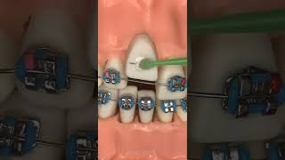 Orthodontics procedure brases bracket fixed music safe ☝️🤔❤️ [upl. by Htomit]