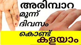 skin wart fast treatment How to remove wart അരിമ്പാറകളയാൻ മൂന്ന് ദിവസം Malayalam health tips [upl. by Aliahs]