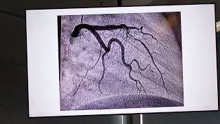 Mayer Miocardiopatía hipertrófica apical [upl. by Irej]