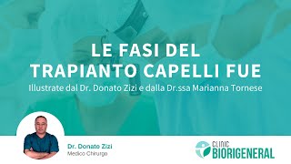 Le fasi del Trapianto di Capelli Micro FUE illustrate dal Dr Zizi e dalla Drssa Tornese [upl. by Ximenez]