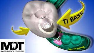 TI Base Implant Crown Design With Exocad  Model Creator Bonus Implant TiBase Design Tutorial [upl. by Otrepur]