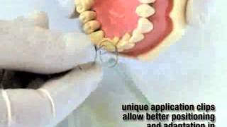 FiberSplint  Dentistry  teeth stabilization amp splinting by Polydentia [upl. by Caril]