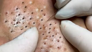 Big Cystic Acne Blackheads Extraction Blackheads amp Milia Whiteheads Removal Pimple Popping  3951 [upl. by Christabel]