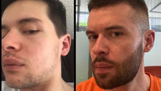 Barbe en 3 Mois  Comment faire pousser sa barbe rapidement  Avoir une barbe avec le Minoxidil 5 [upl. by Itsirk]