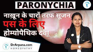 PARONYCHIA नाख़ून के चारों तरफ सूजन व पस की दवा  PANARITIUM Role of Homeopathy [upl. by Esenej]