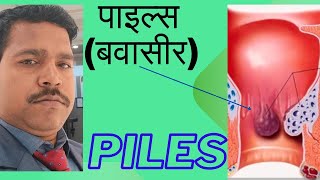 Hemorrhoids Treatment in Hindi  Piles ka Ilaj  पाइल्स के कारण लक्षण डायग्नोसिस और उपचार [upl. by Gomer]