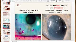 Non infective keratitis [upl. by Manoff56]