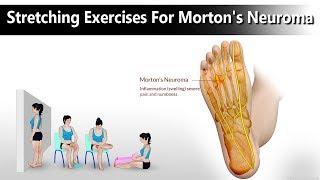 4 Stretching Exercises For Mortons Neuroma Foot [upl. by Rigby]