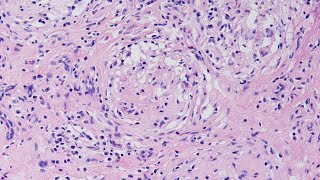 A Case of Granulomatous Orchitis  Pathology mini tutorial [upl. by Ielarol]