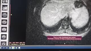 Utilizando Software MR Quantif para estudos de Hemocromatose [upl. by Fairbanks]